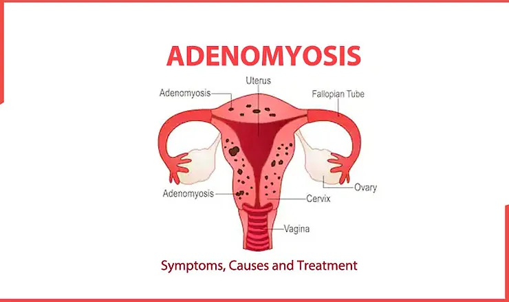 Arete Health | Adenomyosis
